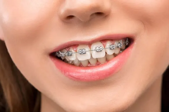 close up of girl with metal braces